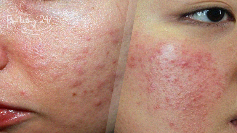 Dị ứng kem trộn do sử dụng sai cách