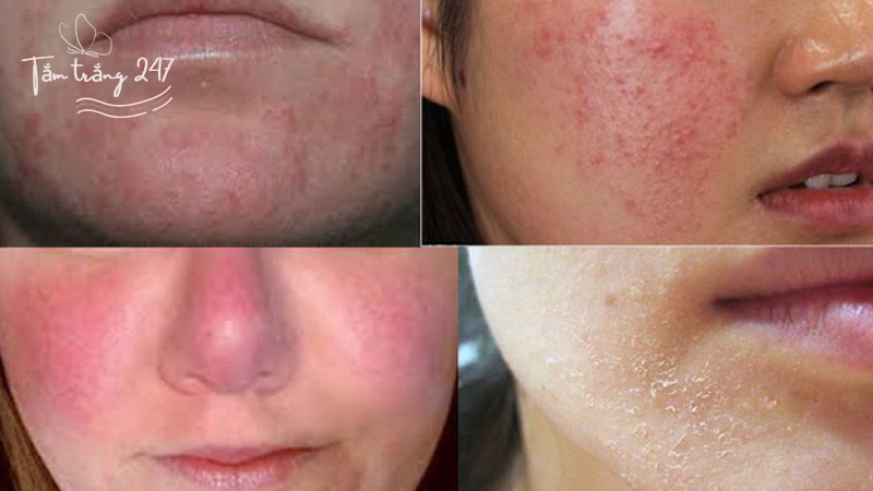 Kem trộn là gì mà gây bào mòn da